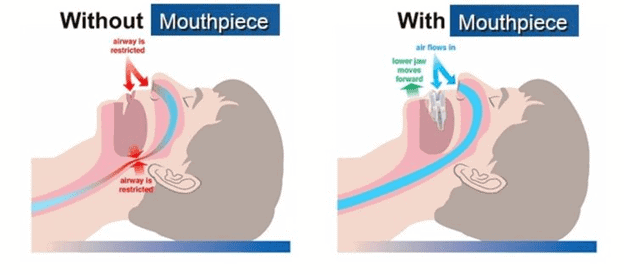 Mouthpiece for Stopping Snoring